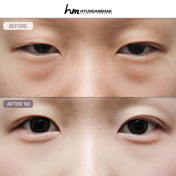 눈밑지전후 얼굴은 젊게 회복은 빠르게