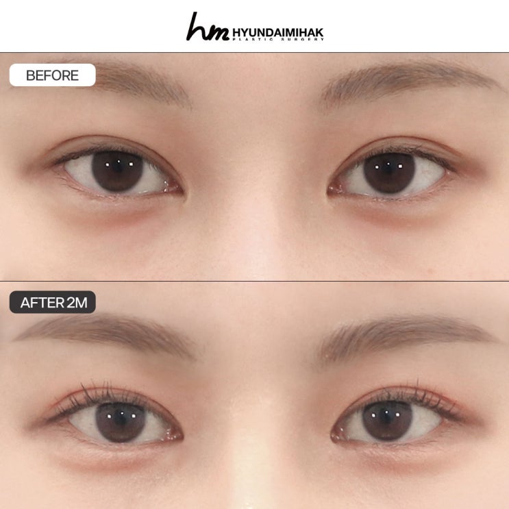 앞트임복원비용 후회 없는 수술을 원한다면