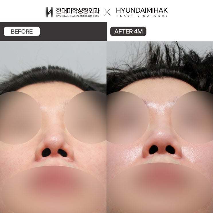 찝힌코재수술 원인 및 해결방법과 예방법