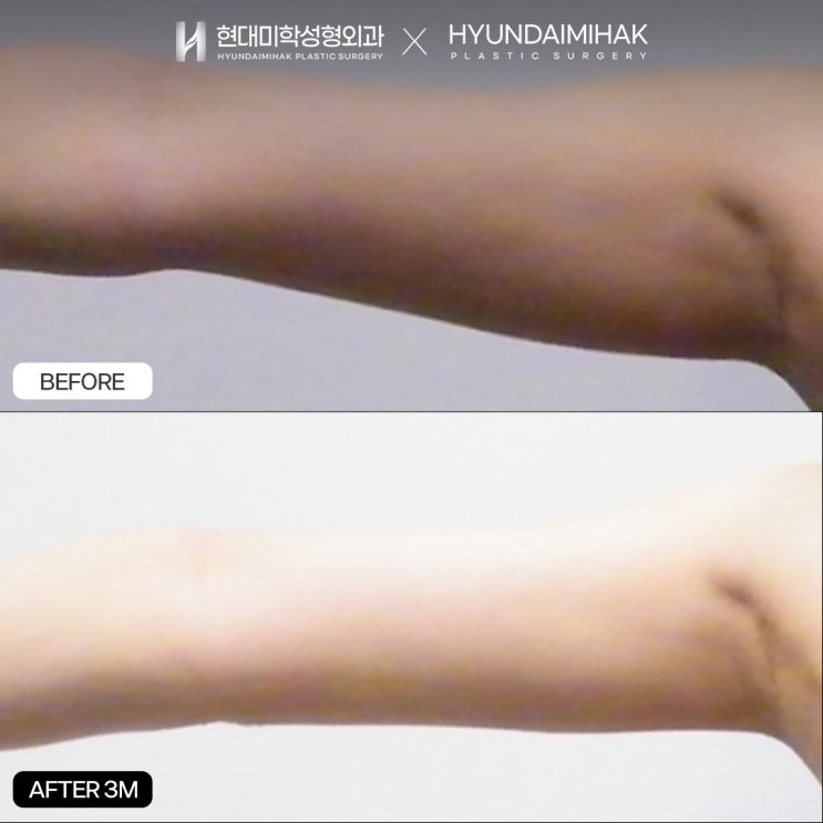 팔뚝미니지방흡입 즉각적이고 안전하게 아름다워지는 법