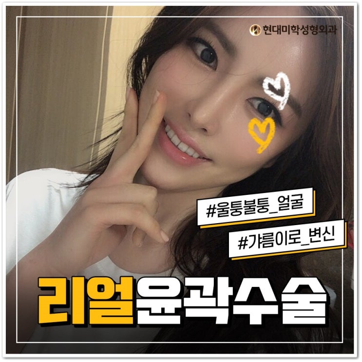 광대축소술가격 예술이네
