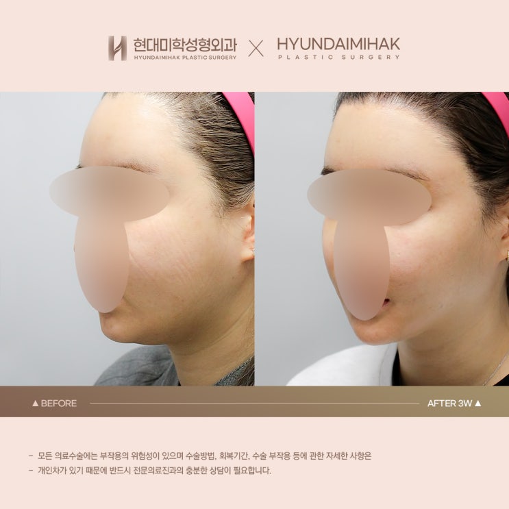 이중턱지방흡입전후 얼굴 라인 정돈 효과