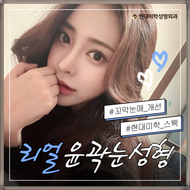 서울쌍꺼풀재수술 이제 성공하세요