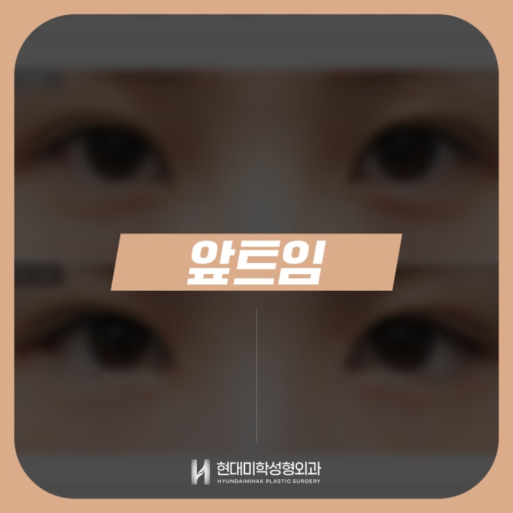 앞트임수술 자연스럽고 또렷한 눈매의 비밀
