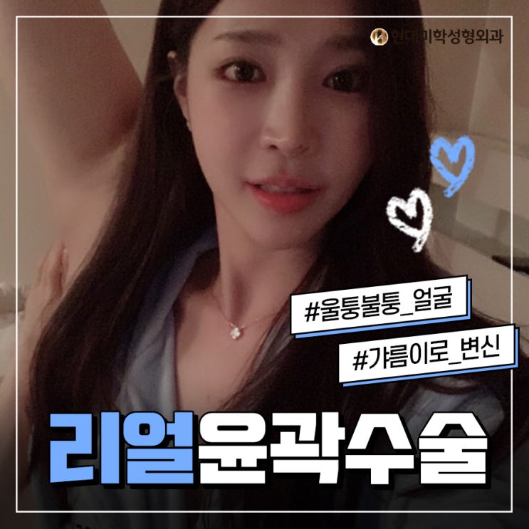 안면교정 자연스럽게 완성