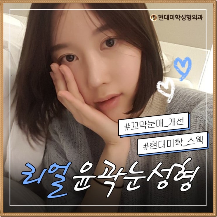 쌍커풀재수술비용 다시돌리기