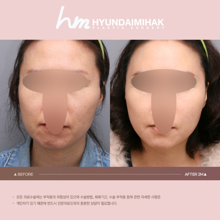 중년리프팅 50대 이후에도 젊음을 유지하자