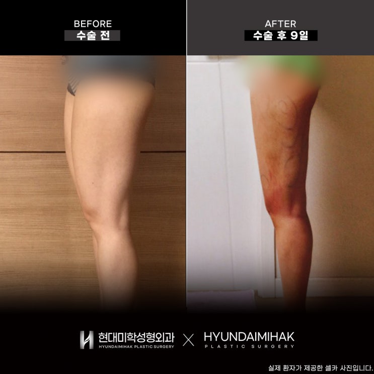 지방흡입성형외과 선택이 바디를 바꾼다