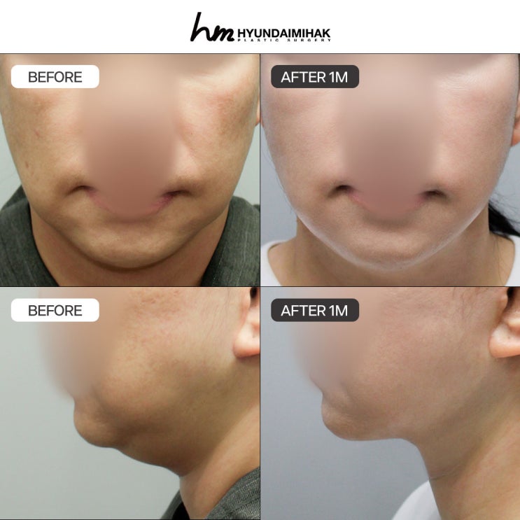 신사역실리프팅 효과부터 실 종류별 장단점까지