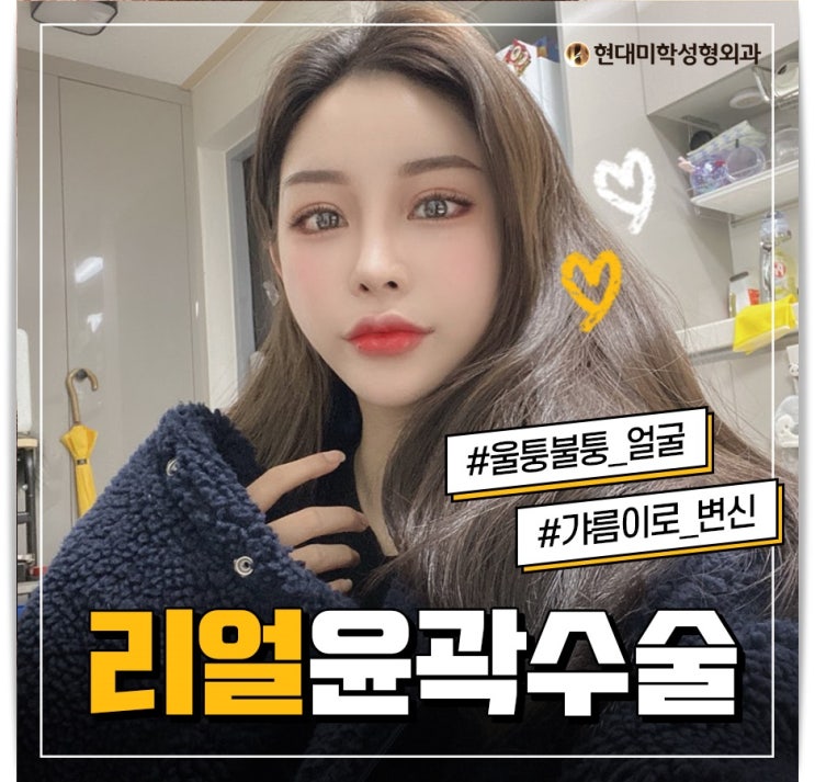 안면윤곽술 결과로 보여준다
