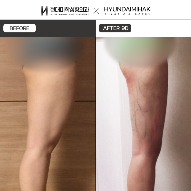 쁘띠지방흡입 단 하루만에 고민 종결해주는 간편 바디라인 완성법