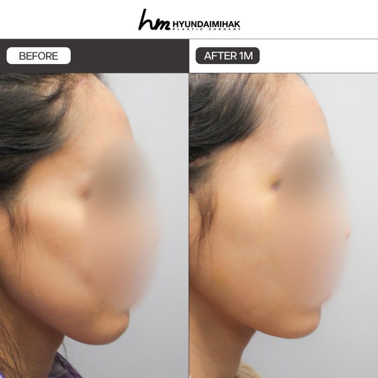 얼굴살주사 자연스럽고 탄력있게 슬림라인 완성