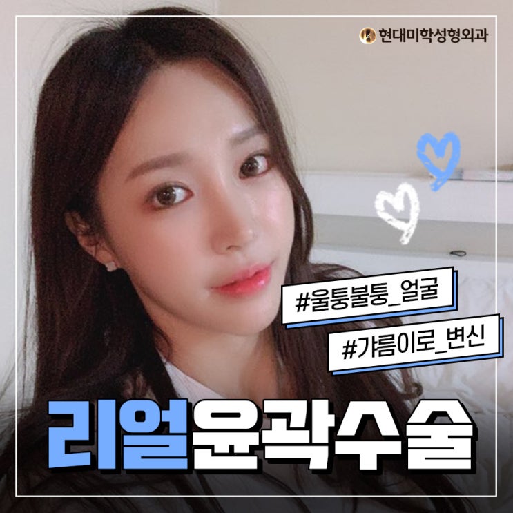 아래턱수술 워너비 라인으로