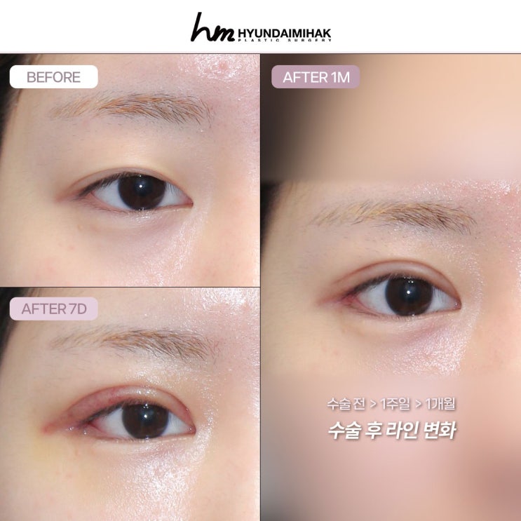 듀얼트임후기 작고 답답한 눈 확실하게 바꾸는 법