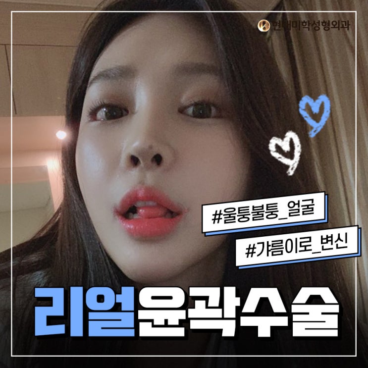 사각턱수술후기 고민하지말고