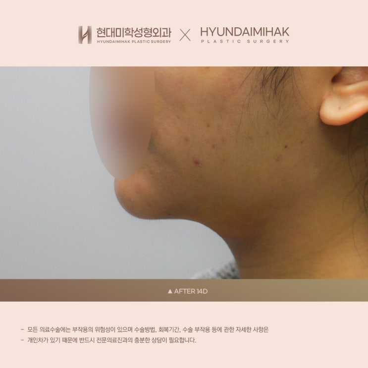 심부볼성형 리프팅으로도 해결되지 않는 얼굴형 교정법