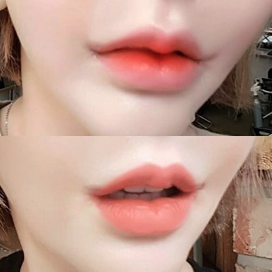 인중수술 스트레스 타파
