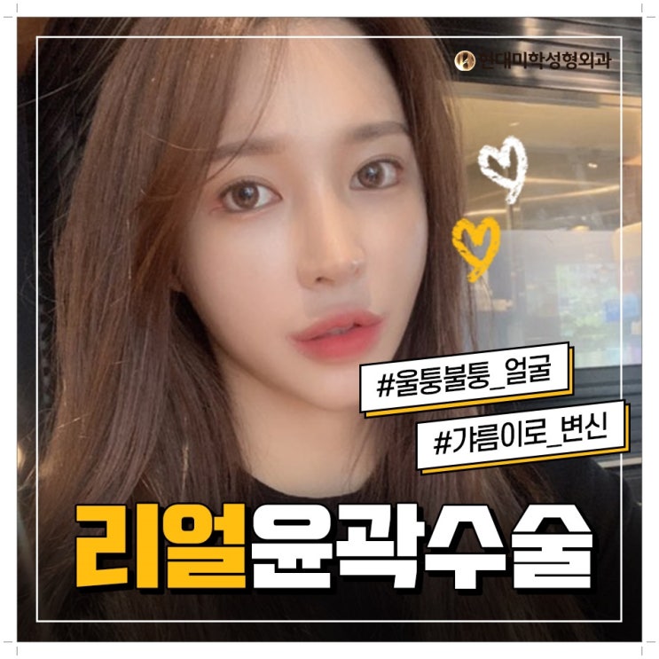 사각턱축소술비용 정말짱이야