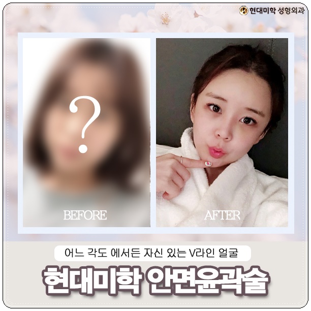 안면비대칭교정 황밸완성