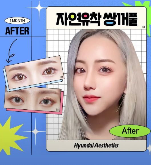 쌍꺼풀수술잘하는곳 이게 달랐어요.