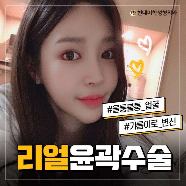 턱끝축소술후기 남들이 부러워 해