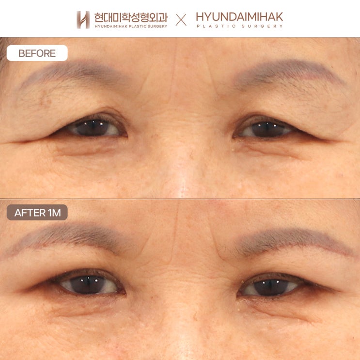 눈썹거상수술 젊은 인상을 유지하려면
