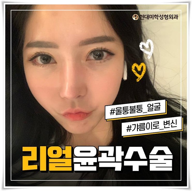 광대재수술 문제를 개선해