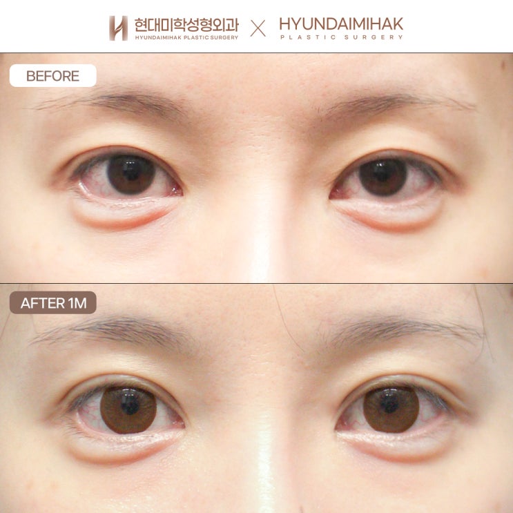 쌍수재수술잘하는곳 반복되지 않으려면