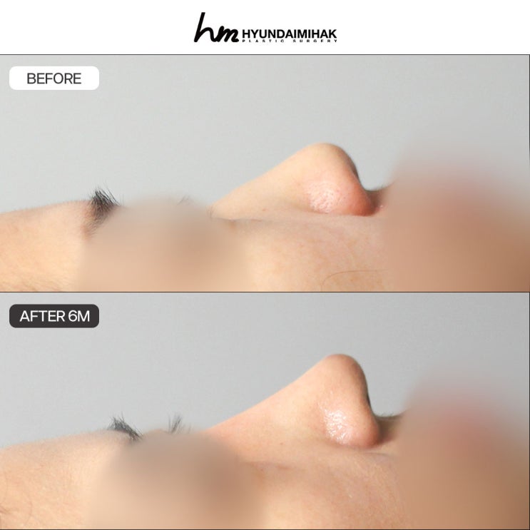기증늑자가늑 코성형 왜 현대미학에서 받으면 좋을까
