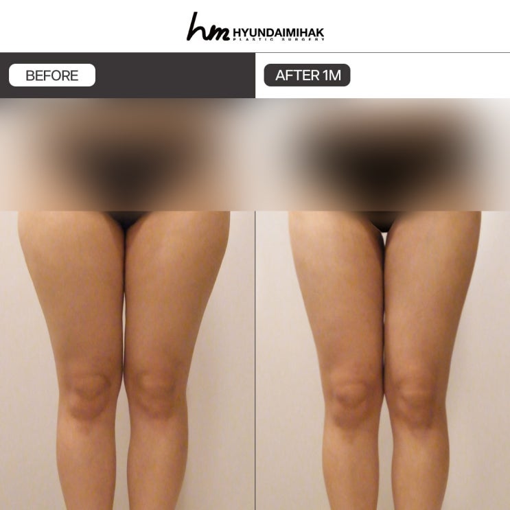 하체지방흡입 자신감이 달라지는 해결책