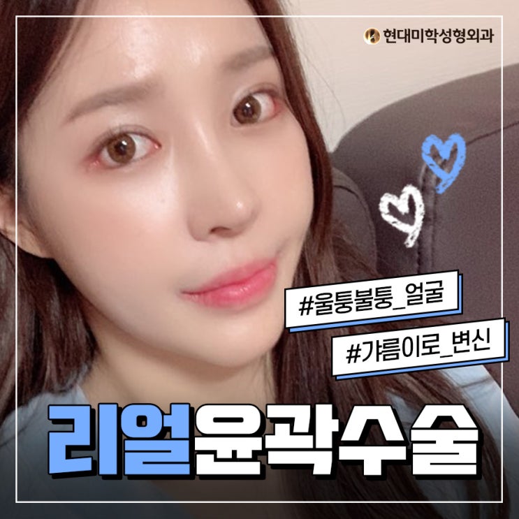 광대뼈축소술 세련된 라인 원해?