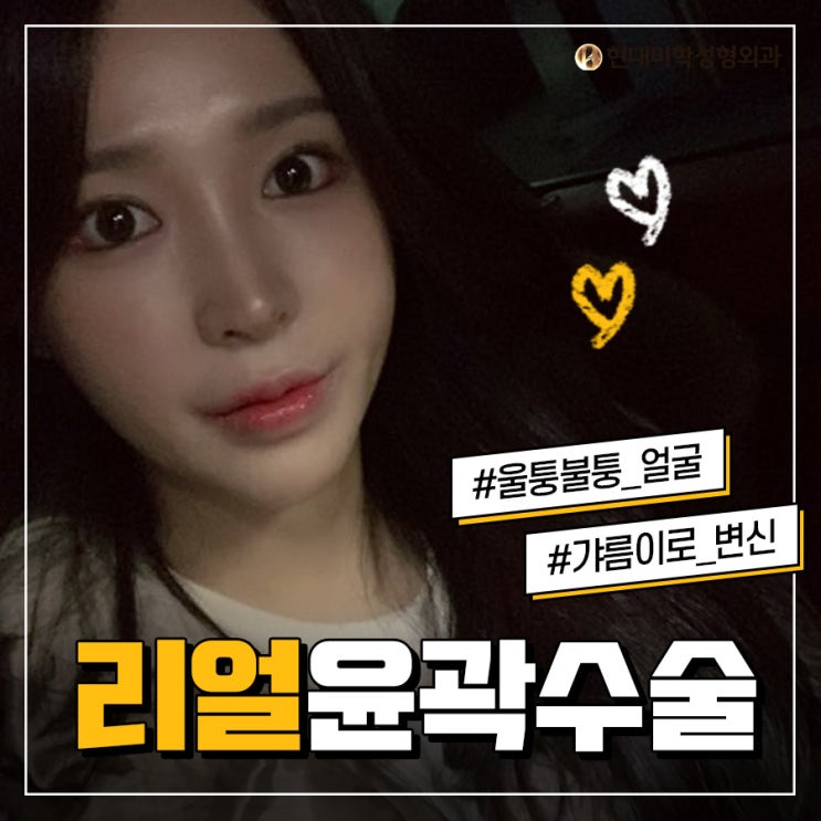 사각턱성형외과 갸름하게 완성해요