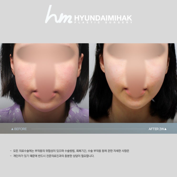 스마스리프팅 최소절개 최대효과의 안티에이징 솔루션
