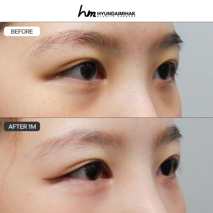 신사역눈성형외과 첫인상 바꾸는 비밀
