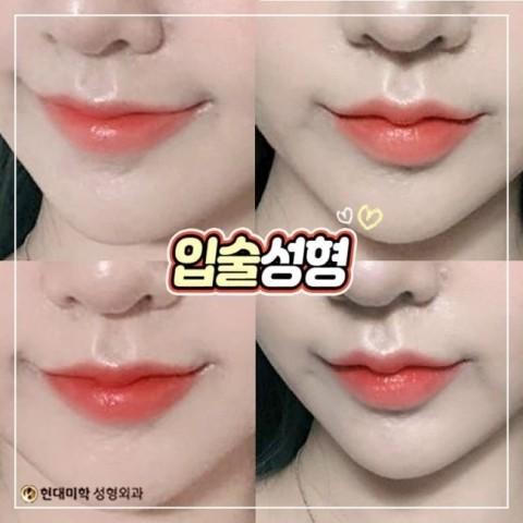 입술비대칭수술 균형잡히니까 예쁘다