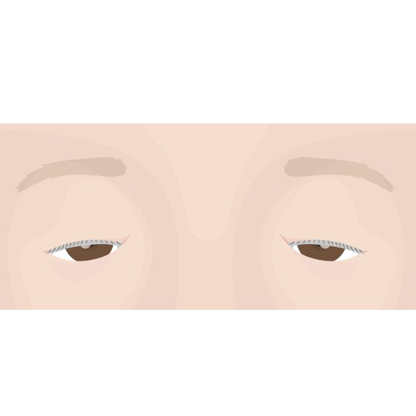 눈머리(내안각)를 덮는 몽고주름