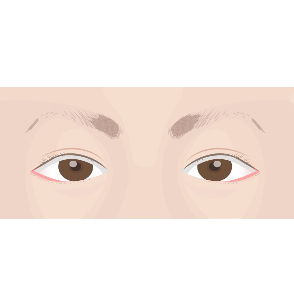 아래 눈꺼풀 가장자리