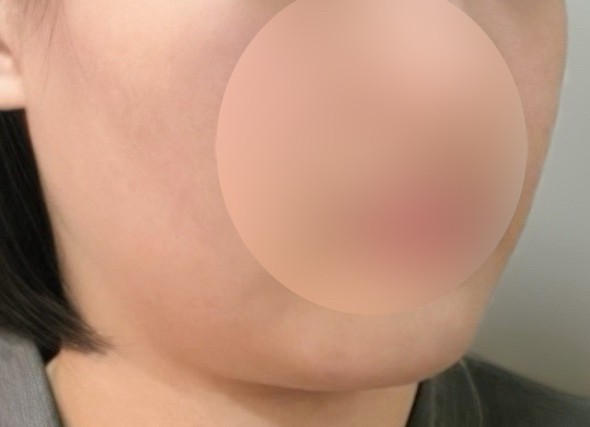 실리프팅 후기