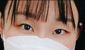 눈재수술 후기
