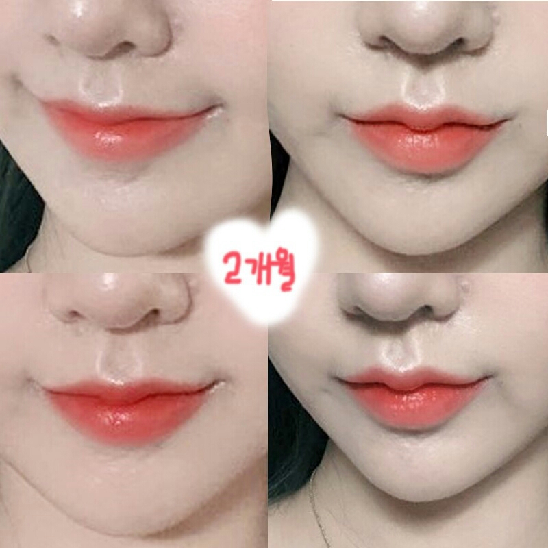 입꼬리성형 후기