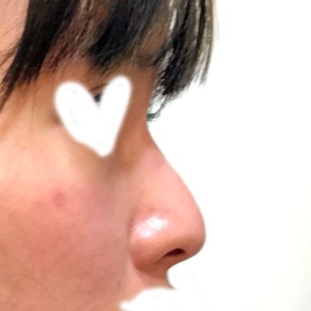 코재수술 후기