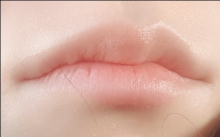 입꼬리성형 후기