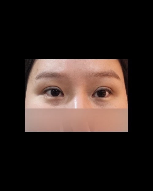 눈재수술 후기