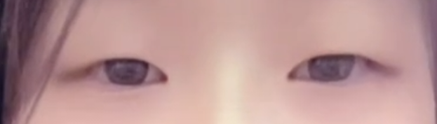 쌍꺼풀(매몰) 후기