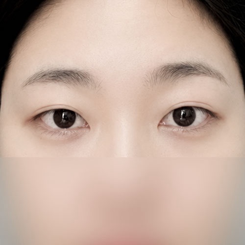 쌍꺼풀(자연유착) 후기