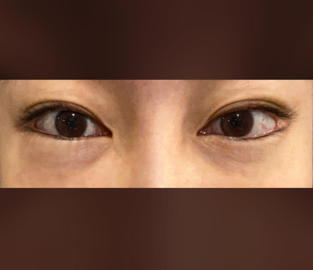 눈재수술 후기