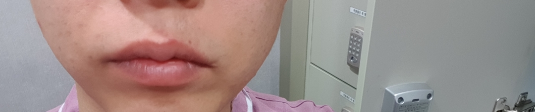 입꼬리성형 후기