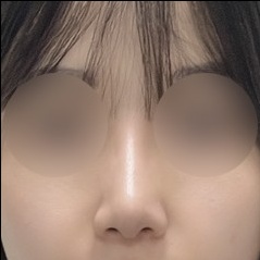 얼굴지방분해주사 후기