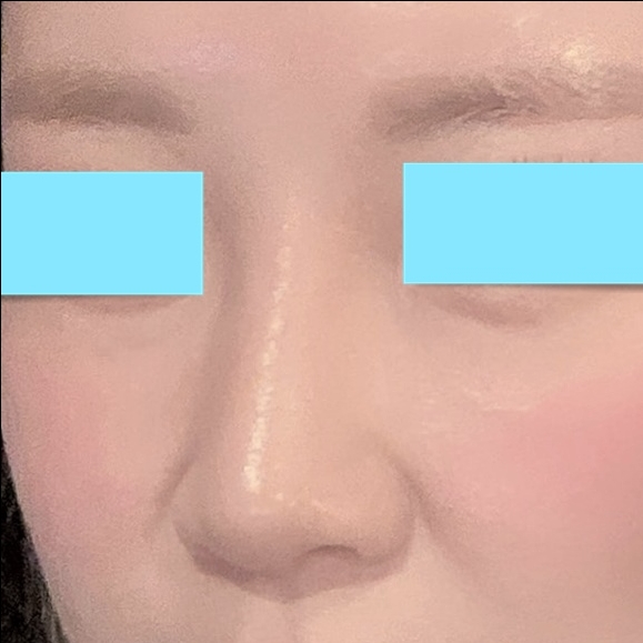 콧대(보형물) 후기