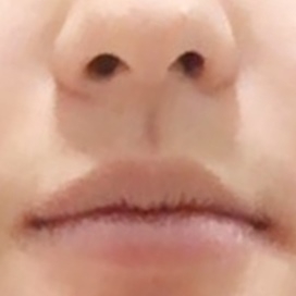 입꼬리성형 후기